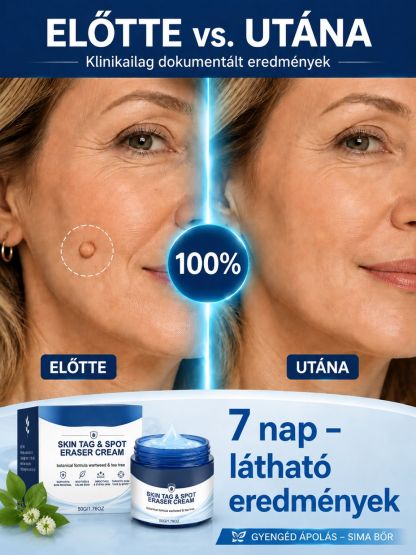 👍Prémium Bőrhiba Eltávolító Krém – Fájdalommentes és Természetes Formula (50% Akció)