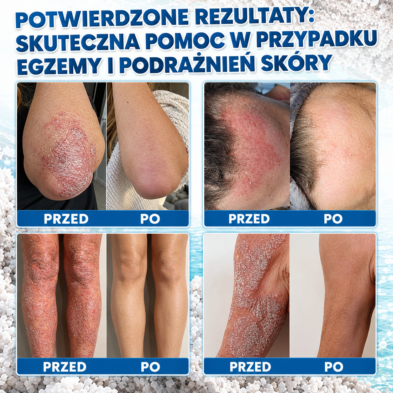 ⭐Medistart® PSZORIÁZIS SPECIÁLIS BŐRÁPOLÓ