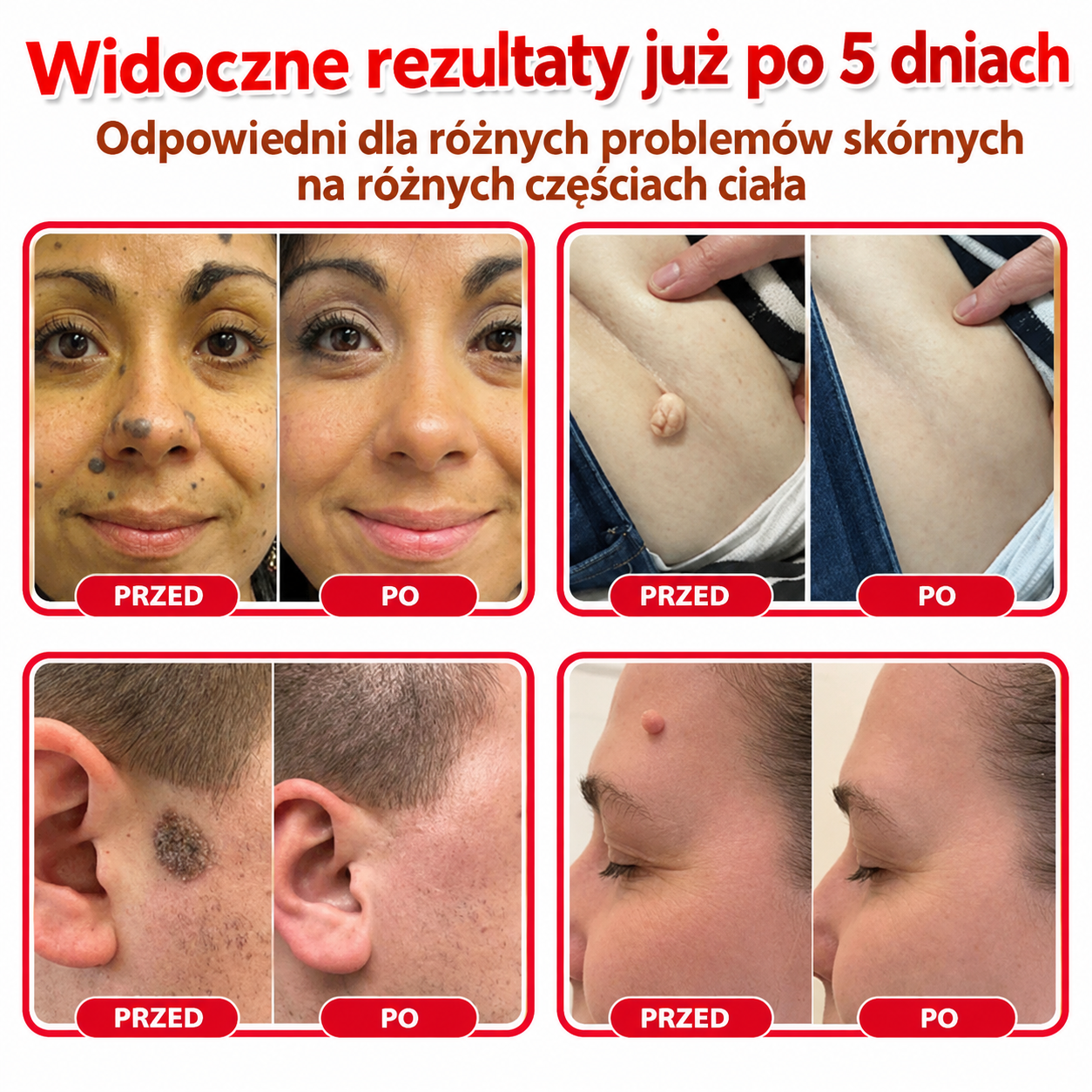 Botaniczny plaster z mikroigłami do usuwania włókniaków skórnych