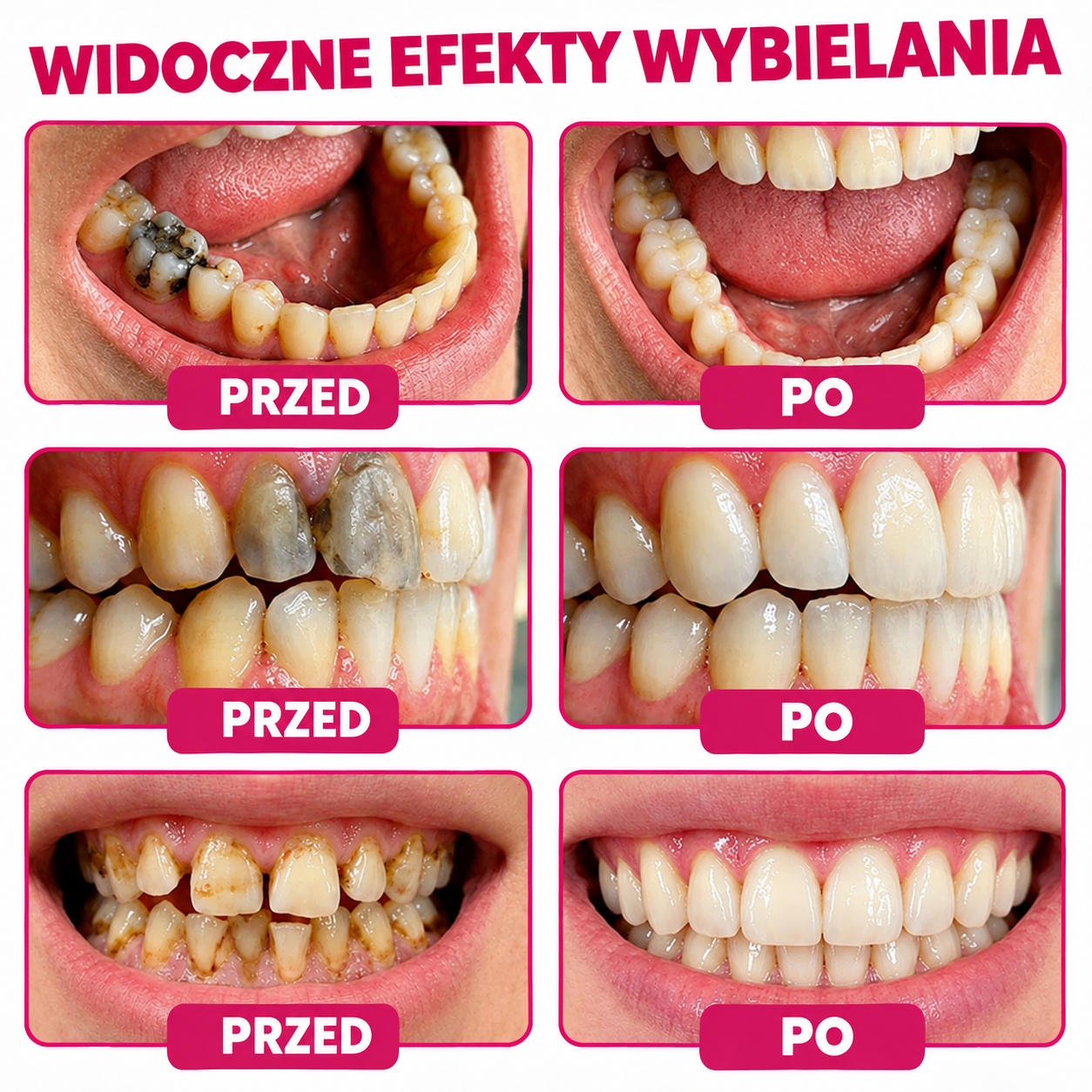 Relimoy® DenPerm – naturalny żel do wypełniania ubytków i odbudowy szkliwa