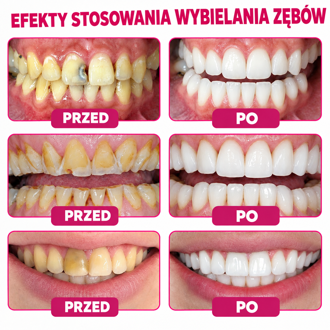 Relimoy® DenPerm – naturalny żel do wypełniania ubytków i odbudowy szkliwa