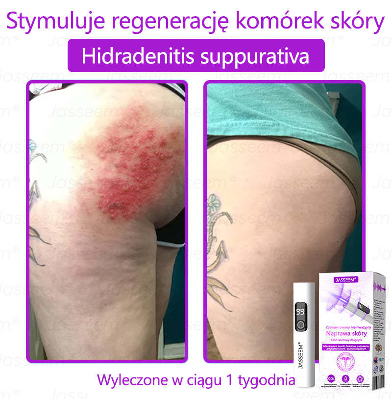 𝐉𝐚𝐬𝐬𝐞𝐞𝐦® Pokročilá neinvazivní CO₂ laserová oprava pleti 🎉 (Jemně odstraňuje bradavice, znaménka, stařecké skvrny a kožní výrůstky – bez bolesti. Bez starostí!)