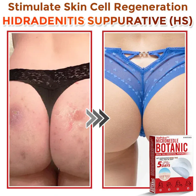 🌈SkinPrikyn™ MicroNeedle Botanic náplast na odstranění kožních výrůstků 🇺🇸 Vyrobeno v USA