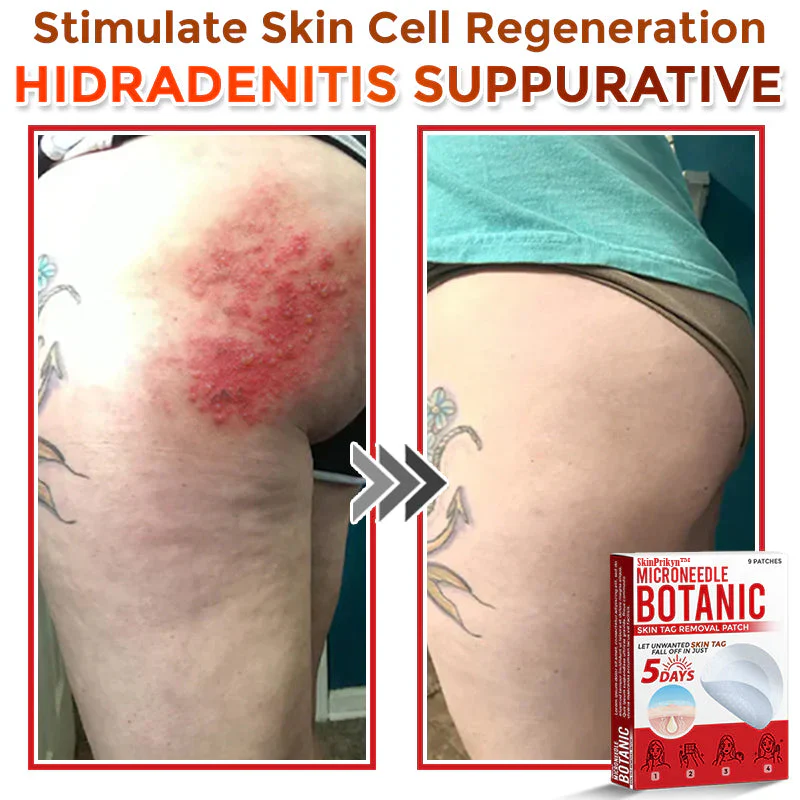 🌈SkinPrikyn™ MicroNeedle Botanic náplast na odstranění kožních výrůstků 🇺🇸 Vyrobeno v USA