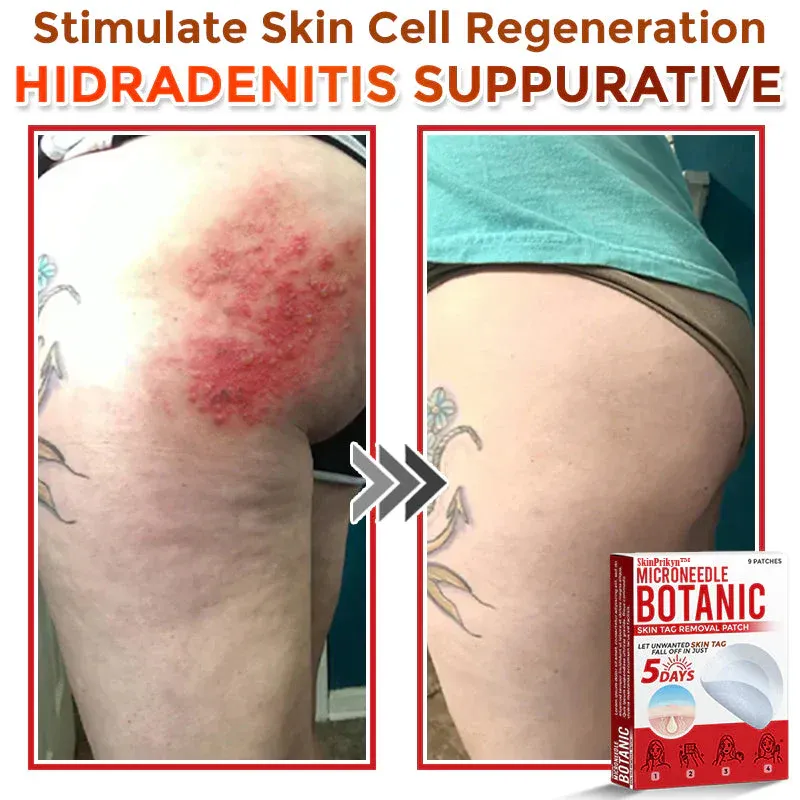 🌈SkinPrikyn™ MicroNeedle Botanic náplast na odstranění kožních výrůstků 🇺🇸 Vyrobeno v USA