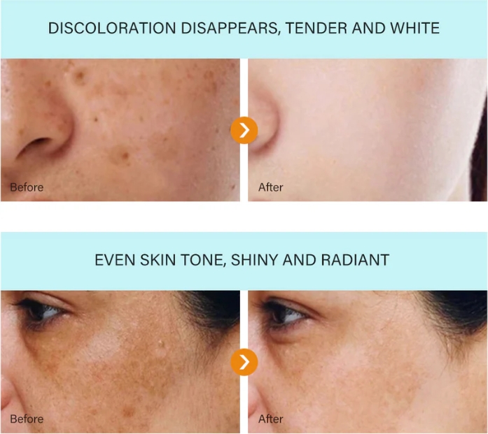 [Oficiální obchod] Bloobeac® Blemish Removing BeautyCream - Zesvětluje tmavé skvrny, pihy a vrásky | Péče proti stárnutí, sjednocující tón pleti