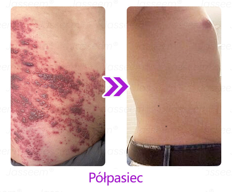 𝐉𝐚𝐬𝐬𝐞𝐞𝐦® Pokročilá neinvazivní CO₂ laserová oprava pleti 🎉 (Jemně odstraňuje bradavice, znaménka, stařecké skvrny a kožní výrůstky – bez bolesti. Bez starostí!)