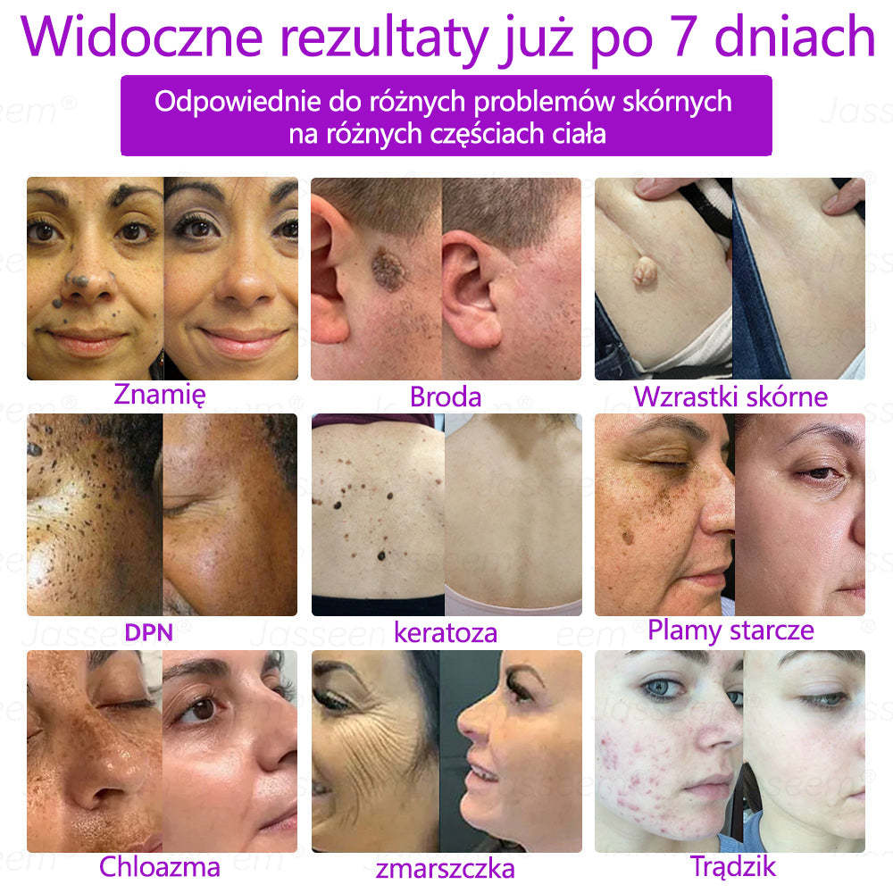 𝐉𝐚𝐬𝐬𝐞𝐞𝐦® Pokročilá neinvazivní CO₂ laserová oprava pleti 🎉 (Jemně odstraňuje bradavice, znaménka, stařecké skvrny a kožní výrůstky – bez bolesti. Bez starostí!)