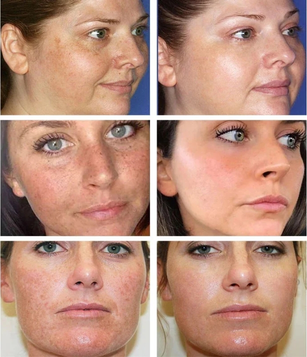 [Oficiální obchod] Bloobeac® Blemish Removing BeautyCream - Zesvětluje tmavé skvrny, pihy a vrásky | Péče proti stárnutí, sjednocující tón pleti