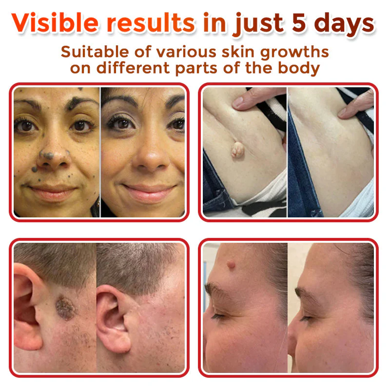 🌈SkinPrikyn™ MicroNeedle Botanic náplast na odstranění kožních výrůstků 🇺🇸 Vyrobeno v USA