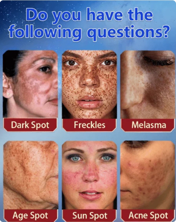 [Oficiální obchod] Bloobeac® Blemish Removing BeautyCream - Zesvětluje tmavé skvrny, pihy a vrásky | Péče proti stárnutí, sjednocující tón pleti
