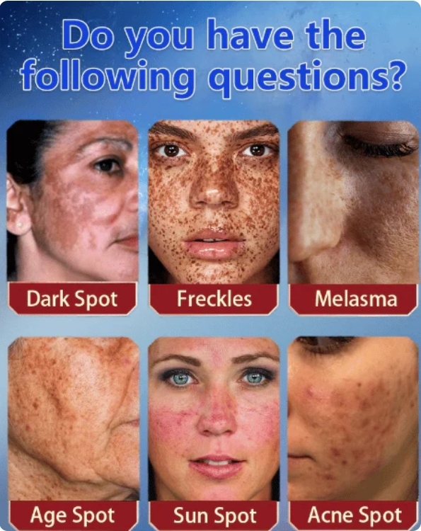 [Oficiální obchod] Bloobeac® Blemish Removing BeautyCream - Zesvětluje tmavé skvrny, pihy a vrásky | Péče proti stárnutí, sjednocující tón pleti
