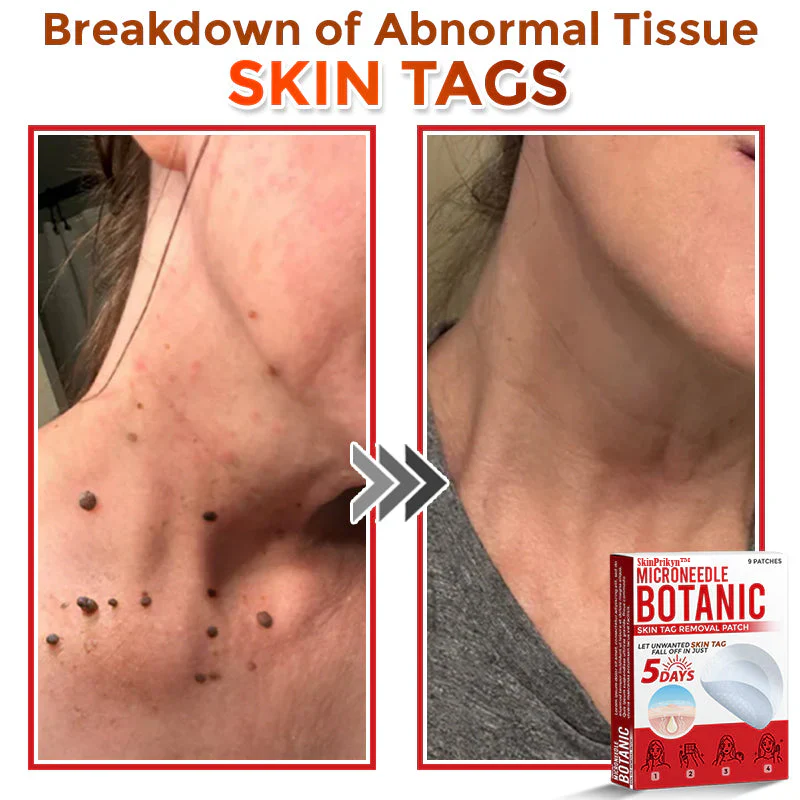 🌈SkinPrikyn™ MicroNeedle Botanic náplast na odstranění kožních výrůstků 🇺🇸 Vyrobeno v USA
