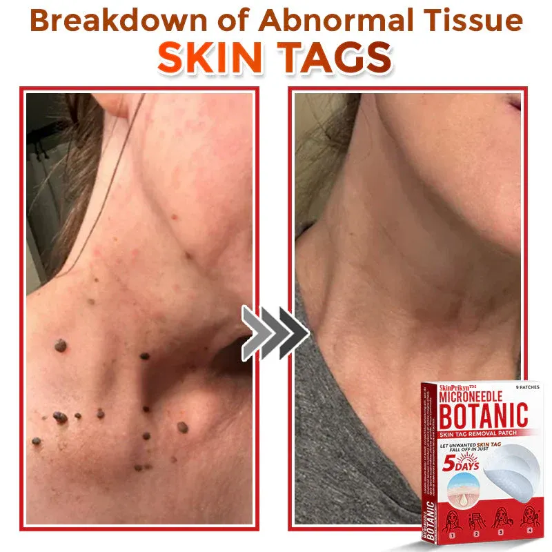 🌈SkinPrikyn™ MicroNeedle Botanic náplast na odstranění kožních výrůstků 🇺🇸 Vyrobeno v USA