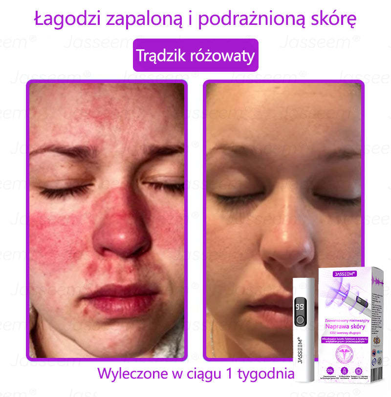𝐉𝐚𝐬𝐬𝐞𝐞𝐦® Pokročilá neinvazivní CO₂ laserová oprava pleti 🎉 (Jemně odstraňuje bradavice, znaménka, stařecké skvrny a kožní výrůstky – bez bolesti. Bez starostí!)