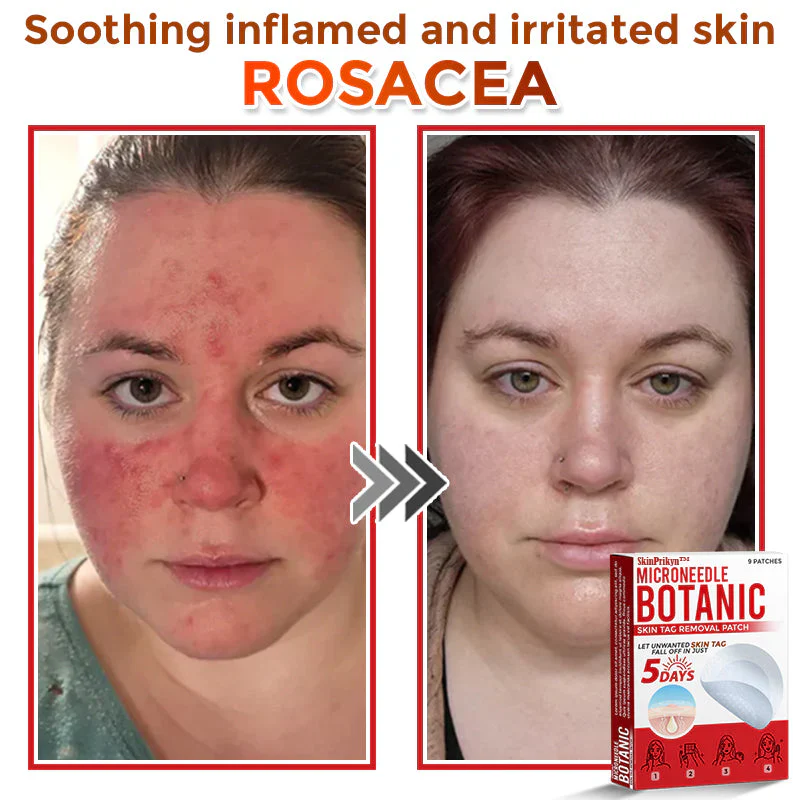 🌈SkinPrikyn™ MicroNeedle Botanic náplast na odstranění kožních výrůstků 🇺🇸 Vyrobeno v USA
