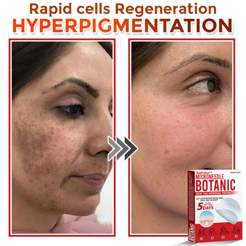 🌈SkinPrikyn™ MicroNeedle Botanic náplast na odstranění kožních výrůstků 🇺🇸 Vyrobeno v USA
