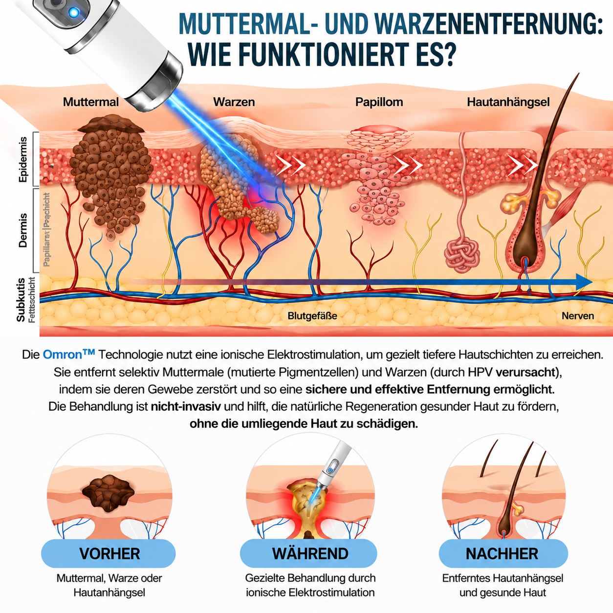 ✨ Omron™ 2026 Multifunktionaler Hautpflege-Stift der neuen Generation – professionelle Lösung zur Entfernung von Muttermalen und Hautunreinheiten. Schmerz- und narbenfreie, nicht-invasive Technologie für eine gesündere und strahlendere Haut. Hergestellt i