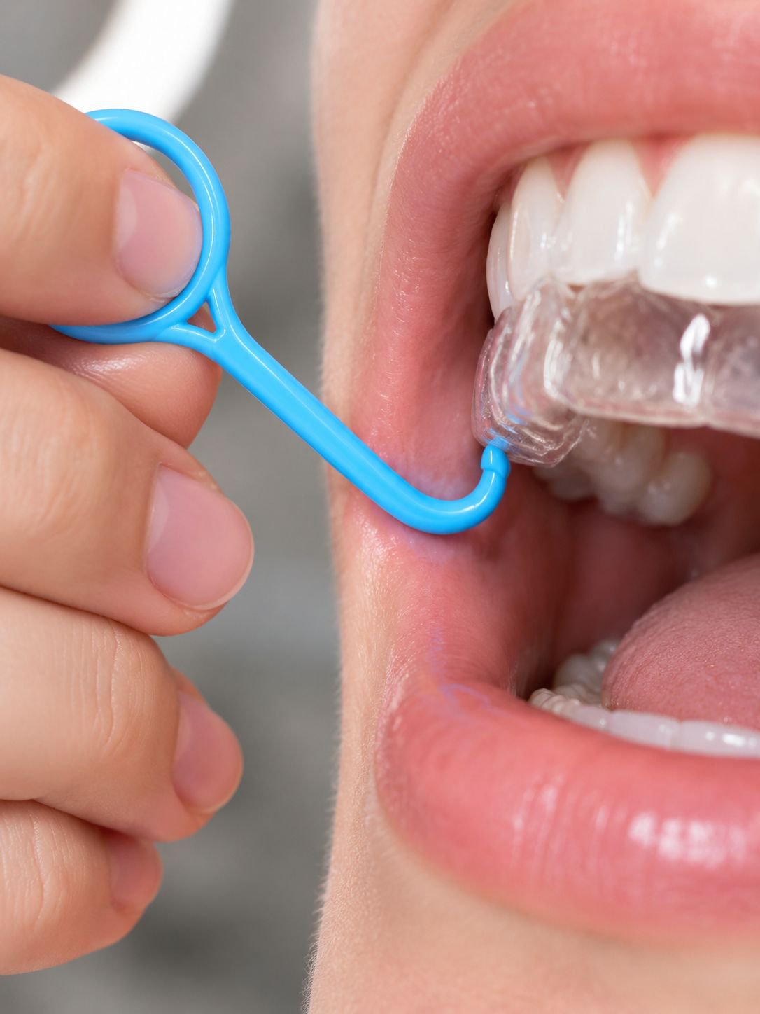 Compact Invisalign remover for daily dental care