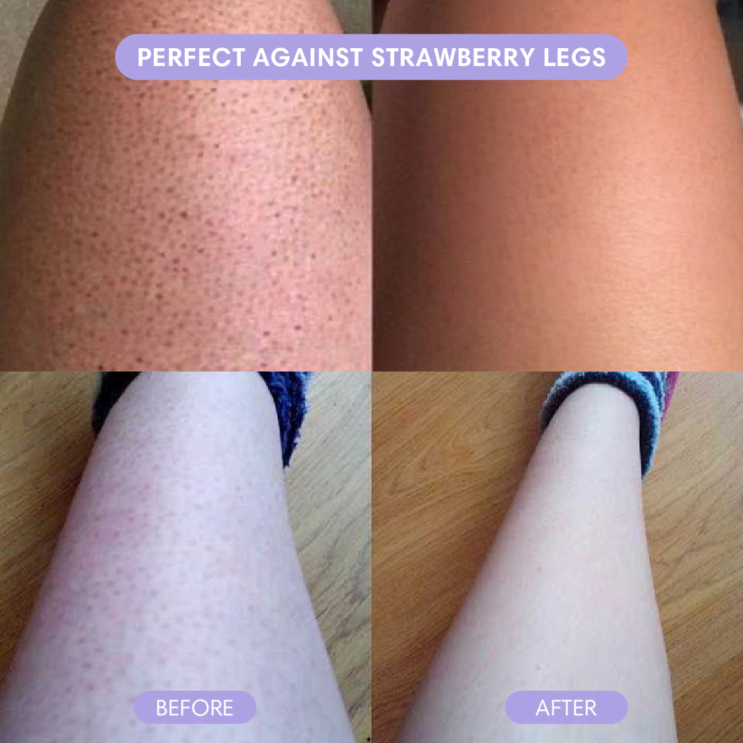 Before and after strawberry legs appearance