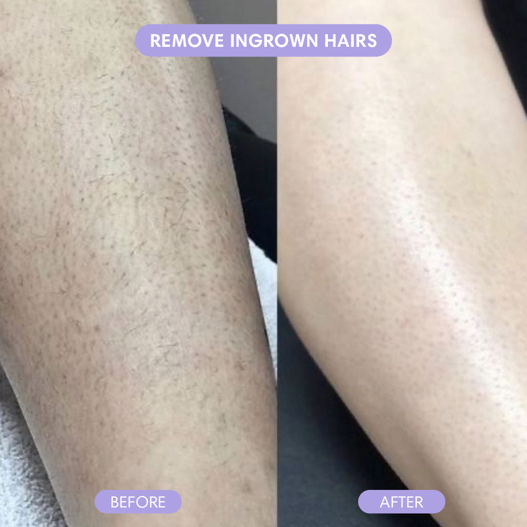 Before and after hair removal