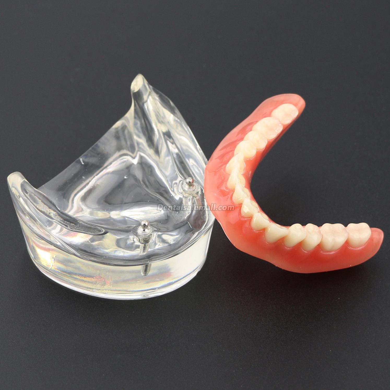 Professional Dental Teeth Model Overdenture Inferior with 2 Implants Study Demo Model 6002 01 image 2