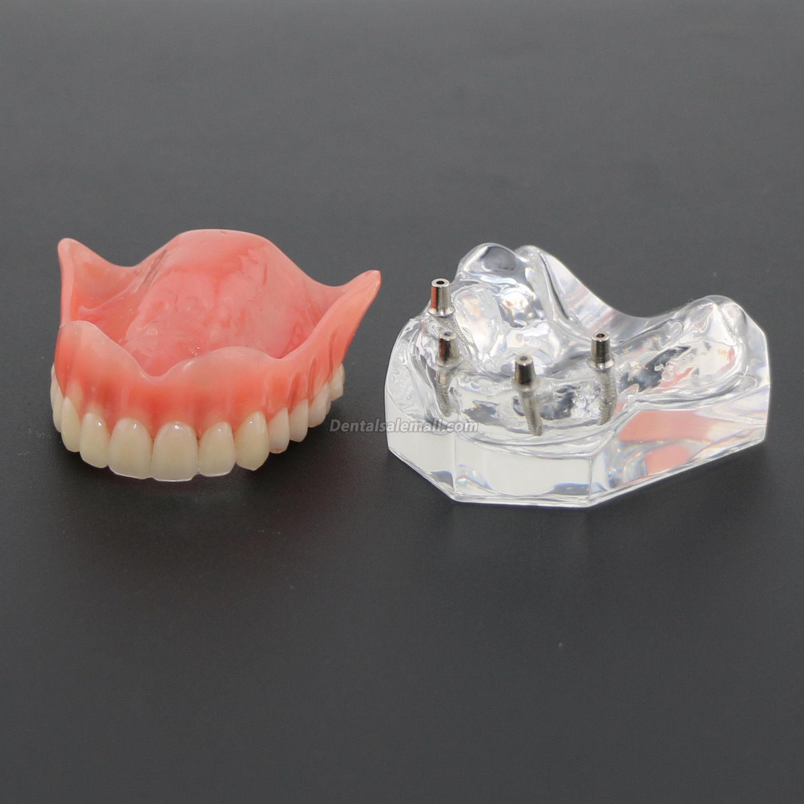 Professional Dental Study Teeth Model Overdenture with 4 Implants Demo Model 6001 image 2
