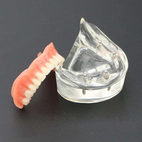 Professional Dental Lower Teeth Demo Study Model 6002 02 Overdenture Inferior 4 Implants image 1