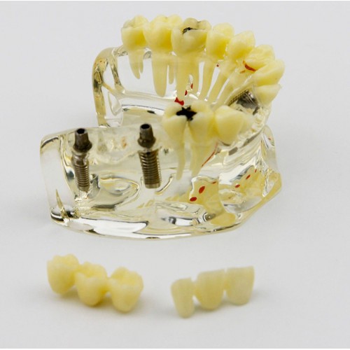 Professional Dental Upper Jaw Implant Model with Bridge and Caries -I 2006 image 1