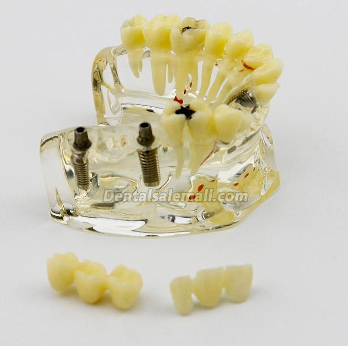 Professional Dental Upper Jaw Implant Model with Bridge and Caries -I 2006 image 2