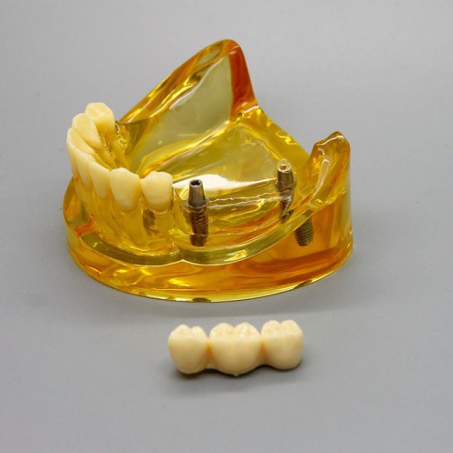Professional Dental Lower Jaw Implant Model with 2 Implants Bridges 2011 image 1