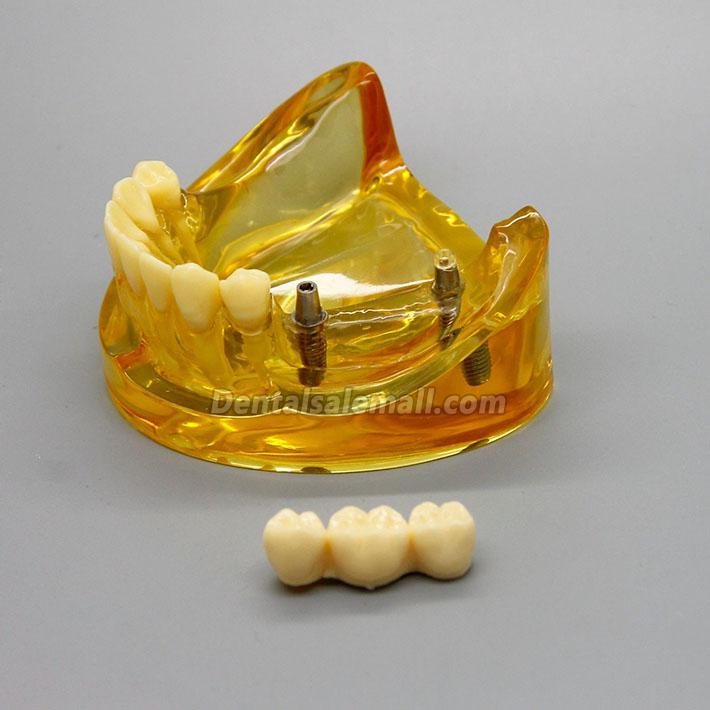 Professional Dental Lower Jaw Implant Model with 2 Implants Bridges 2011 image 2