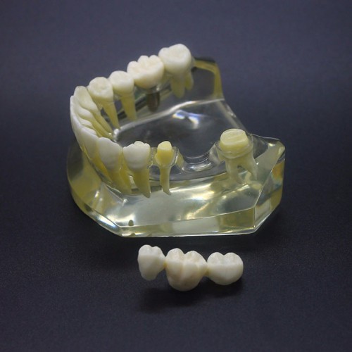 Professional Dental Implant Study Typodont Model Lower Jaw Crown Bridge 2010 image 1