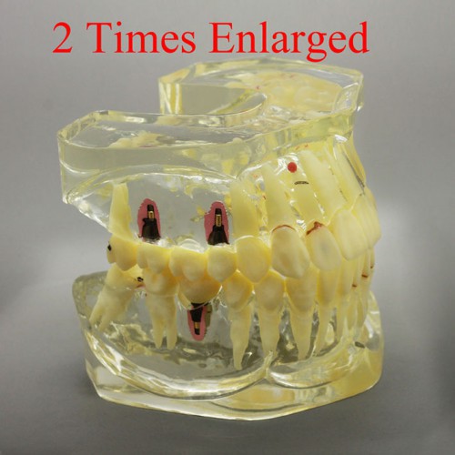 2 Times Enlarged Professional Dental Restoration/ Prothesis/Implant Study Model with Bridge image 1