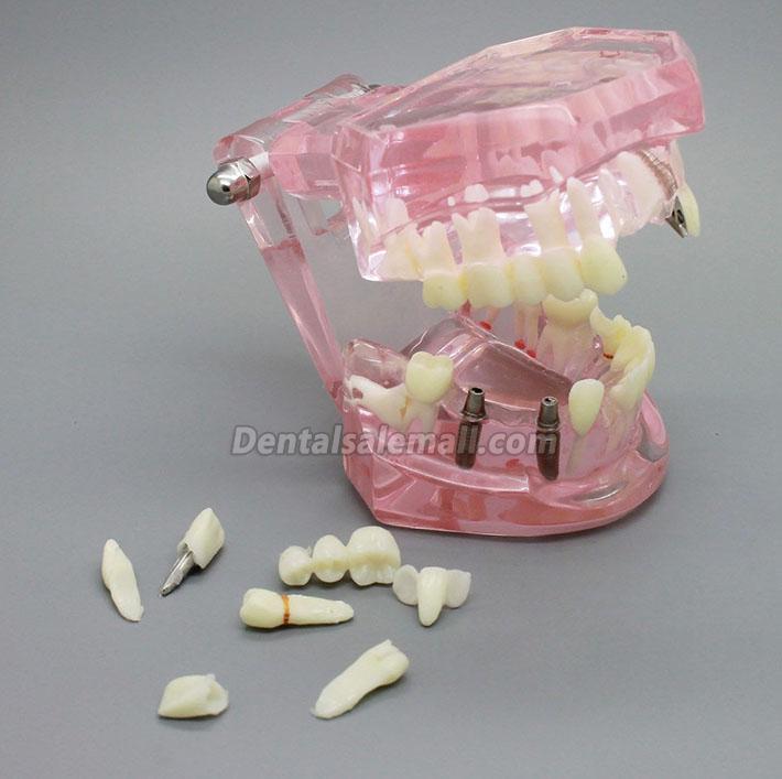Professional Dental Implant Study Analysis Demonstration Teeth Model with Restoration PINK image 2