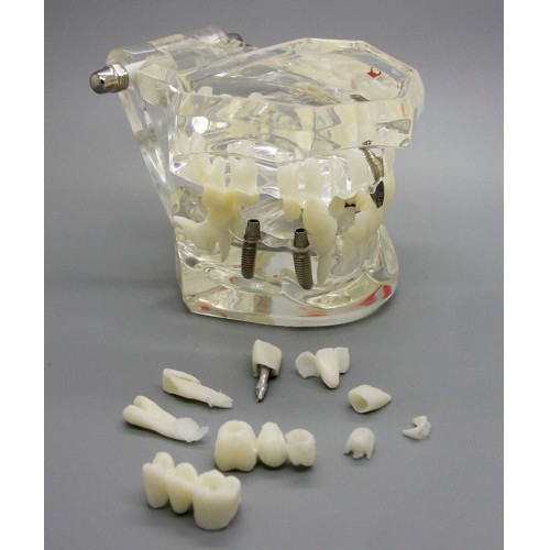 Professional Dental Implant Study Analysis Demonstration Teeth Disease Model with Restoration image 1