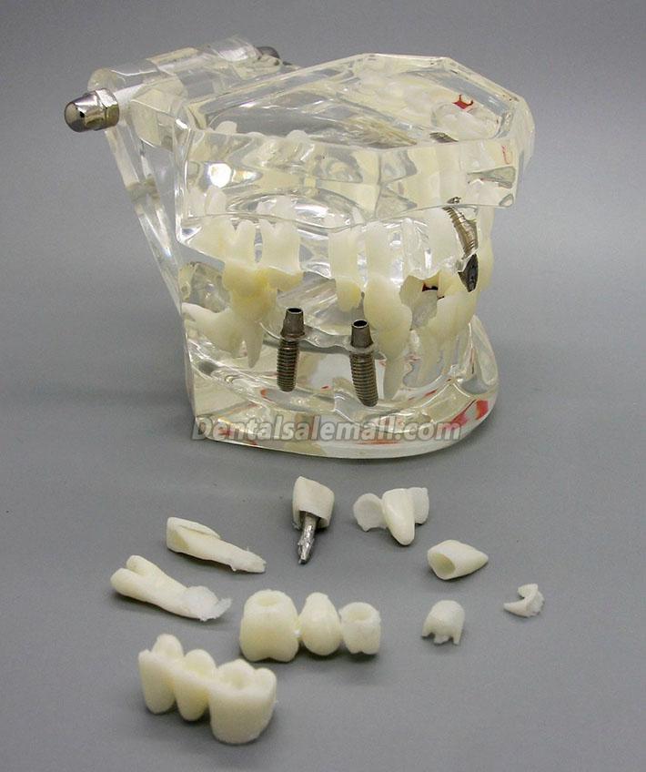 Professional Dental Implant Study Analysis Demonstration Teeth Disease Model with Restoration image 2
