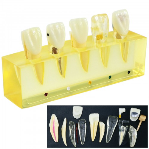 Professional Dental Teeth Model 5Stages Demonstration Endodontic Treatment Root Canal Incisor image 1