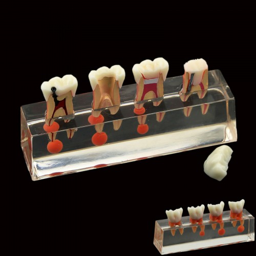 Professional Dental Teeth Model 4-Stage Endodontic Treatment Demonstrates Anatomical M4018 image 1