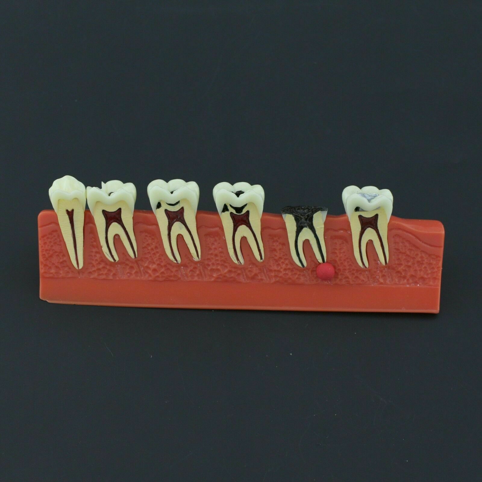 Dental Teeth Disease Model 4 Stages Caries Illustration Typodont 4011, Compatible with NISSIN image 2