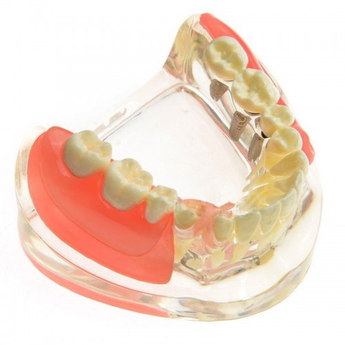 Professional Dental Model Contrast Implant Restoration for Missing Molar Teeth M-6006