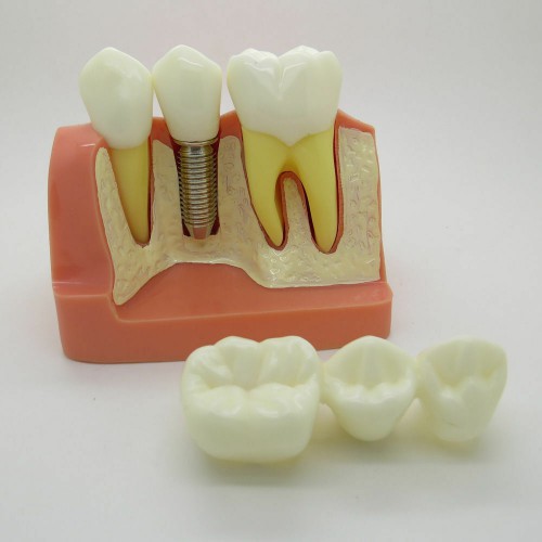 Professional Dental Orthodontics Typodont Implant Analysis Crown Bridge Demonstration Model image 1