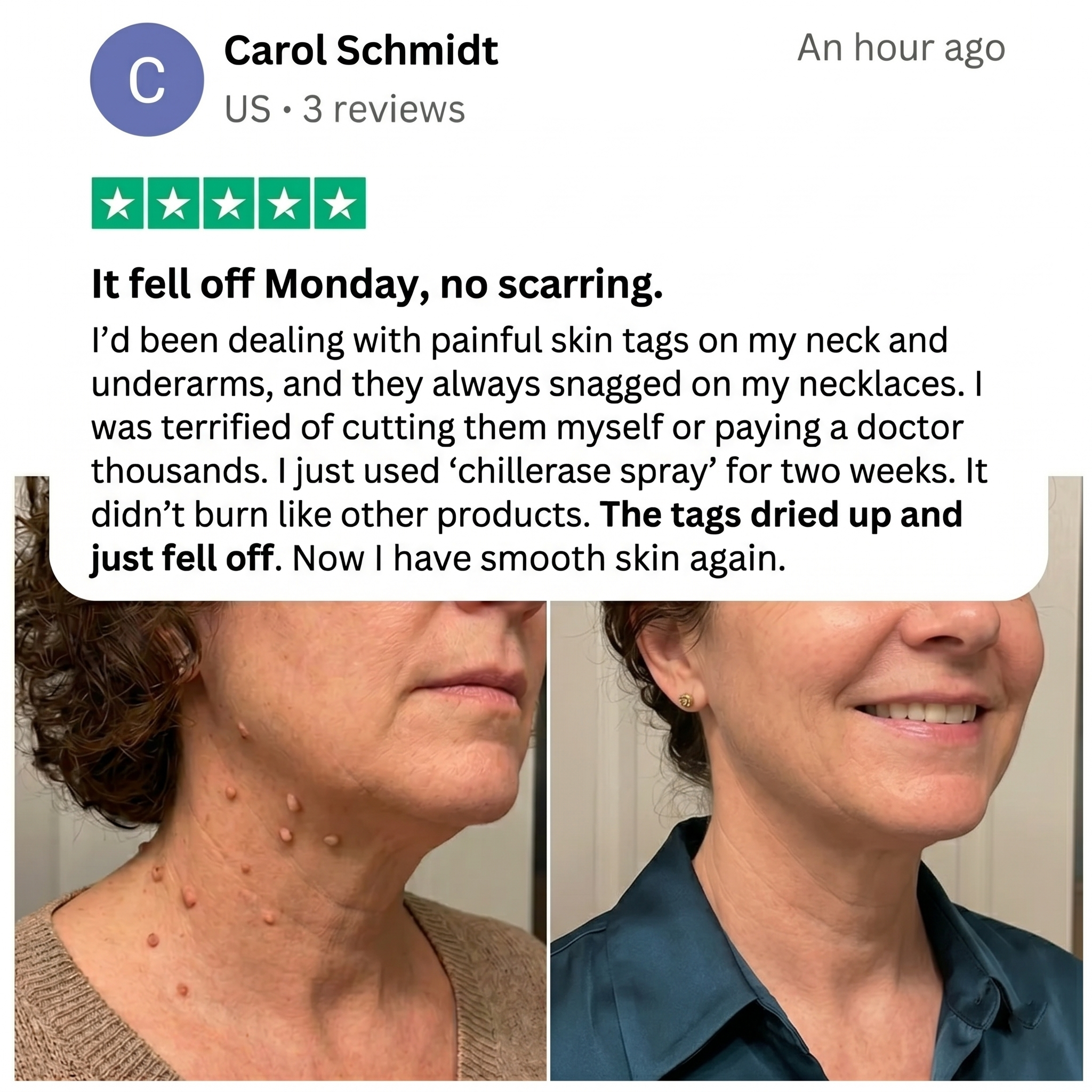 gvahq® Overnight Skin Tag Spray — 3