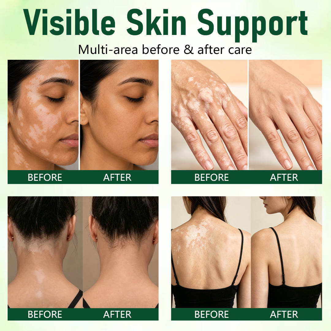 gvahq® Herbal Vitiligo Cream — 4