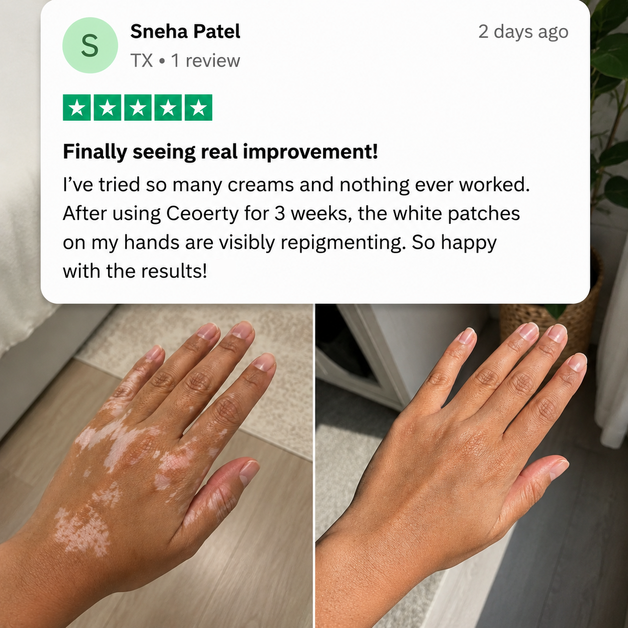 gvahq® Herbal Vitiligo Cream — 3