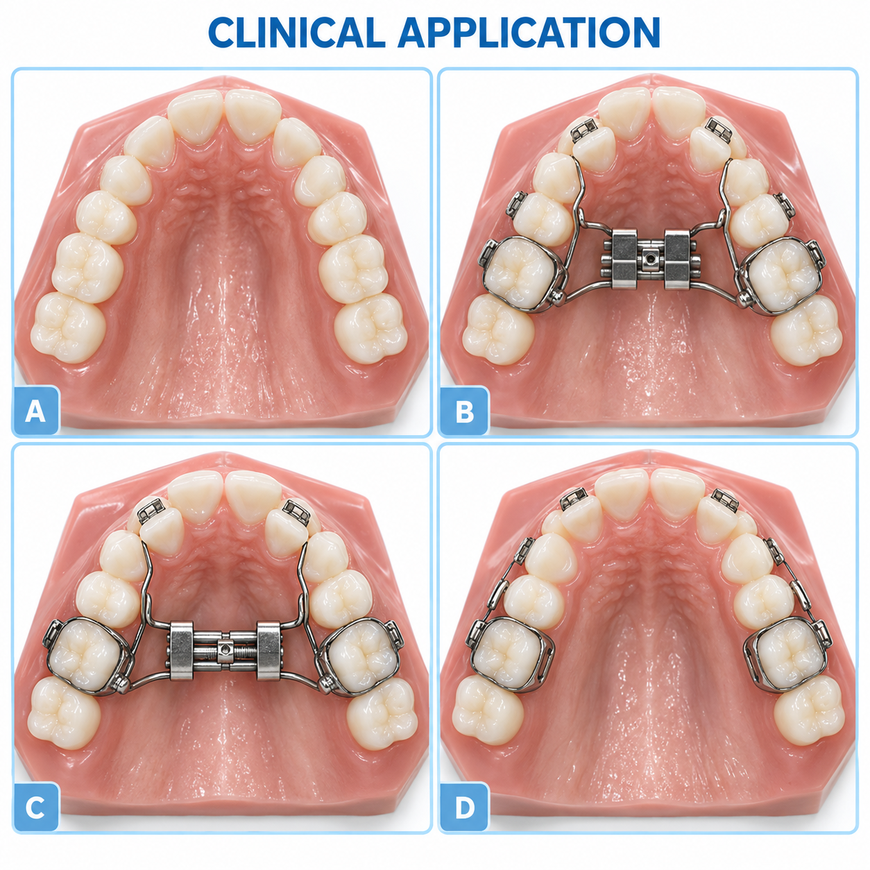 Orthodontic Palatal Expander