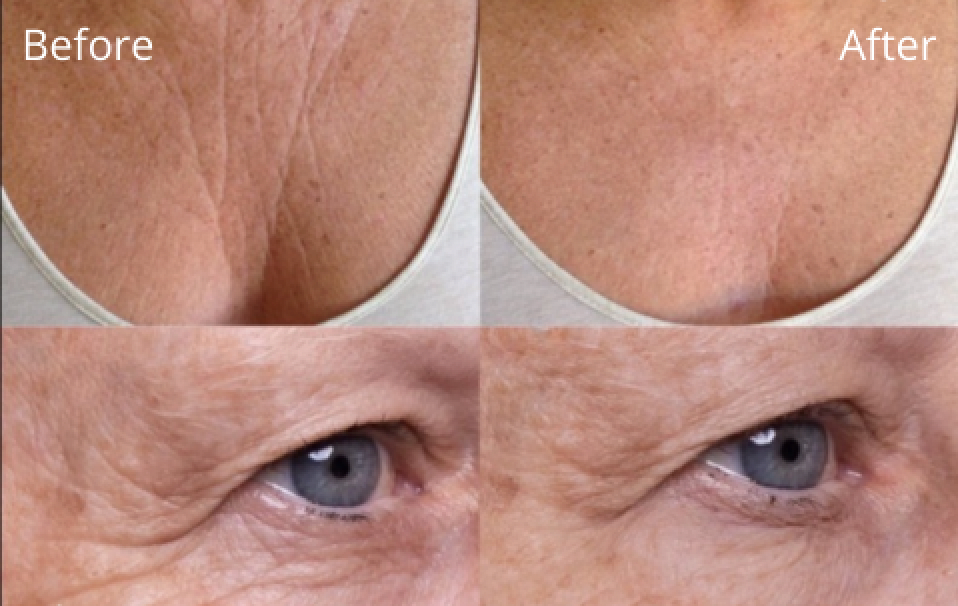 INVISICREPE™ ANTI-WRINKLE FACE AND BODY PATCHES