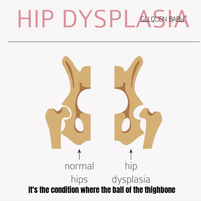 What is hip dysplasia