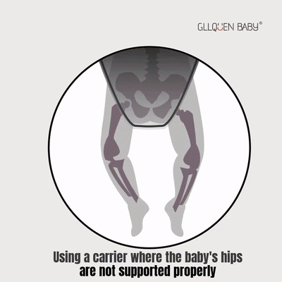 Baby carrier associated with hip dysplasia