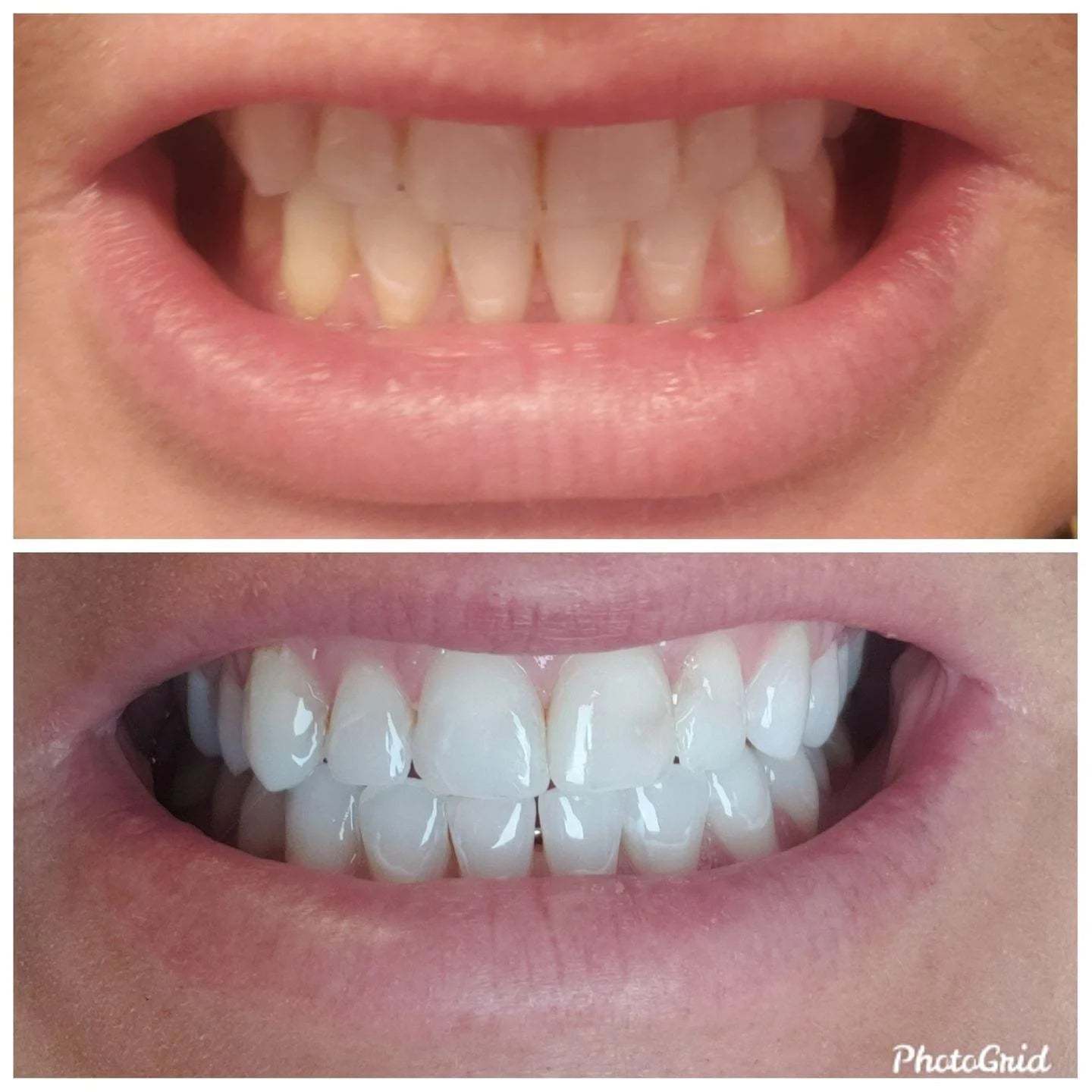 Transparent White Teeth High Strength Whitening Gel Pen-xinru